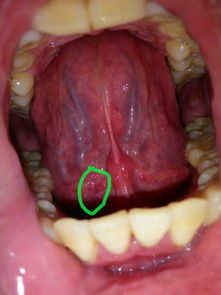 我的舌头下有芝麻大小的小疙瘩,不痛不痒,不知是什么啊 画圈里面那个,舌头根部及舌根两侧也有,不过大 
