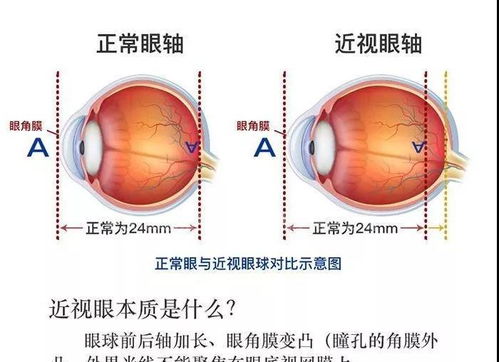 铜仁八中学生 长期戴眼镜,会让眼睛变形