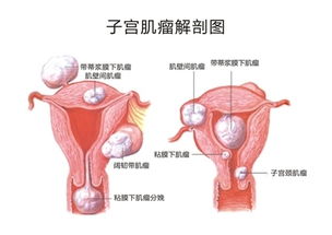 子宫肌瘤一定要切除吗 患有子宫肌瘤可以怀孕吗