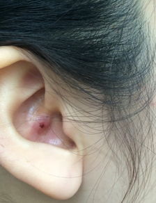 外耳廓上面长痘痘是为什么