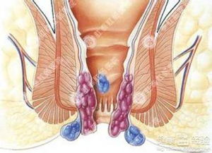 内痔肿痛怎么治
