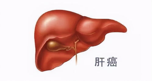 中国亚群OS突破24个月 T药 贝伐珠单抗治疗肝癌最新数据