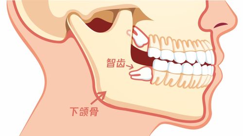 为什么牙医总 劝 人拔掉智齿