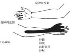 前臂外侧和手指触电样疼痛怎么办 原因 检查 诊断 外科 普外科 症状查询 寻医问药网 