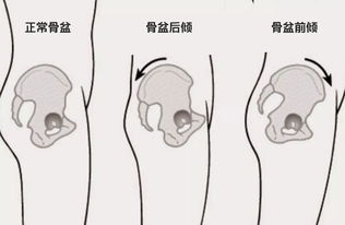 葛优瘫爽吗 小心骨盆前倾