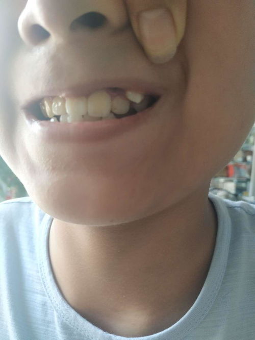 儿子今年12岁,换牙后在上门牙上又多长了一颗 ,医生说不是多余的 要不要做矫正,有时候会戳到上嘴唇 