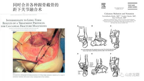 跟骨骨折畸形愈合的治疗