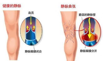 弹力袜穿多久能治好静脉曲张 医生警示 这几点不知道就白穿了