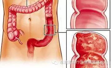 咖啡灌肠助力清除肠息肉