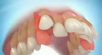 做牙齿矫正为何要经历洗牙 补牙 拔牙三部曲 
