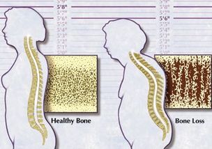 磷高1.76可能会引起一系列的症状，包括骨质疏松、骨折、肾结石、皮肤瘙痒等