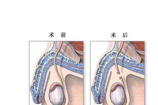 接扎需要多少钱(我要做男性的结扎手术大概多少钱)