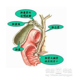 请问胆结石怎么治疗