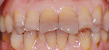 知识普及 怎样区分四环素牙与氟斑牙