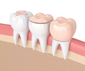 牙桩 牙冠 活动义齿修复材料,怎么选