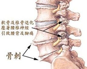 腰椎骨质增生应该如何应对,如何彻底根治 