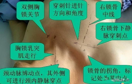 透析了,医生为什么要在病人脖子或腿上插根管子 原来是这种作用 