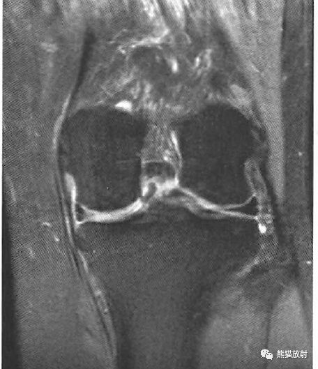 膝关节半月板损伤