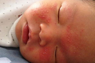 婴儿干性湿疹是缺维生素吗,皮肤干燥缺少什么维生素?