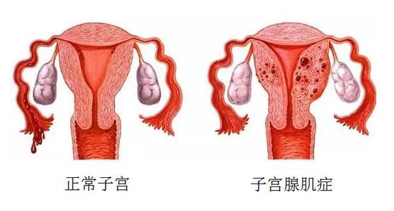 子宫腺肌症能怀孕吗，子宫腺肌症会影响怀孕么