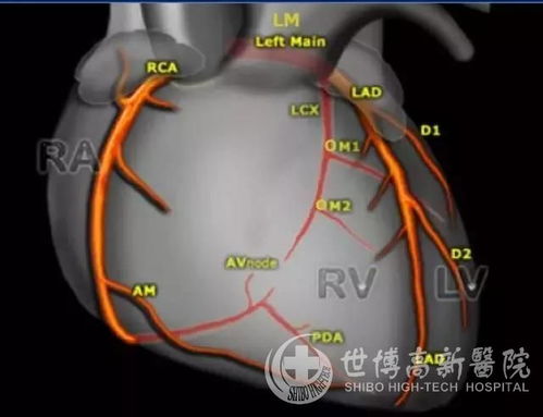 你的 心脏守护者 ,冠脉CTA让心脏血管病变无处遁形