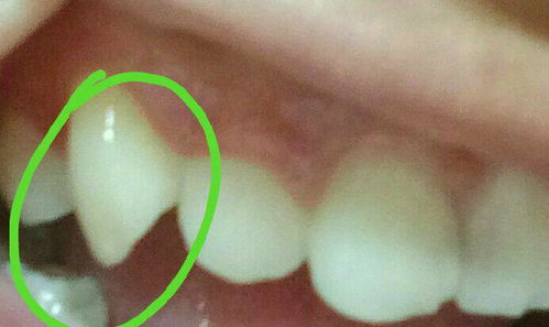 有一颗牙有点凸,怎么弄平整还不伤害牙齿呢 