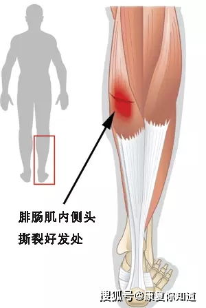 这条关键肌肉影响膝 踝