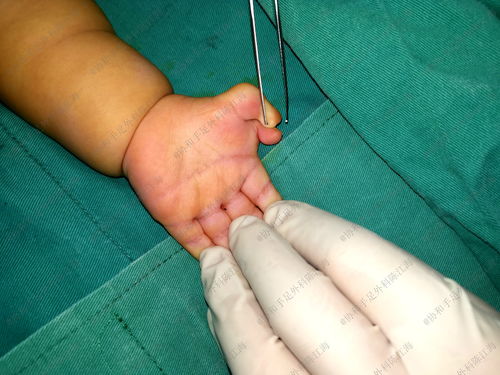 宝宝的左手多指,右手漂浮拇是由哪些原因引起的