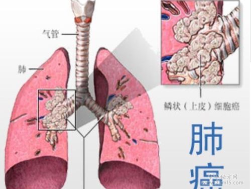 肺癌晚期偏方