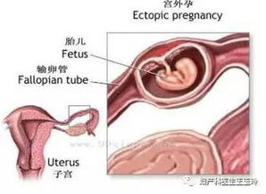 输卵管堵塞怀孕到底有多难