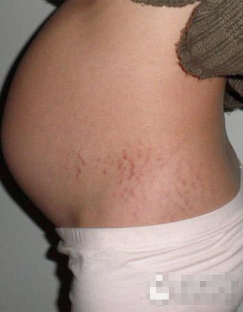 防止妊娠纹(如何能预防妊娠纹)