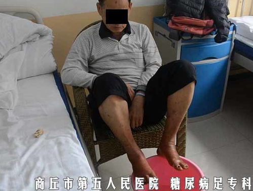 糖尿病足腿脚疼痛为什么不建议中药水泡脚