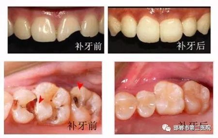 洁牙时出血能立即补牙洞吗(洁牙后出血应急处理)