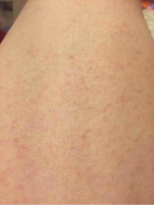 湿疹是怎么引起的呢 多维酸祛疹护肤 