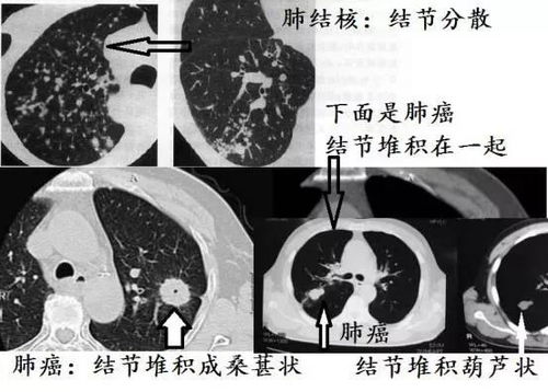 查出肺结节,到底切还是不切