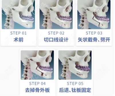 地包天可以自己在家慢慢矫正吗 听说地包天可以自己咬回来