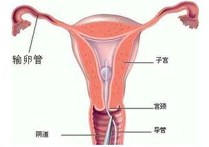 子宫内感染 子宫感染症状子宫感染怎么办