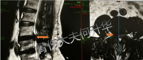 腰椎内固定手术两个月后脚后跟痛是怎么回事(腰椎内固定手术两个月后还痛)