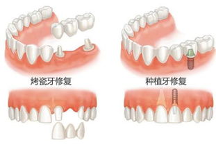 关于种植牙你想问的都在里面