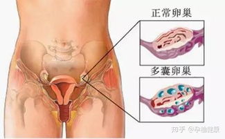 多囊卵巢怀孕几率 多囊不孕几率是多少