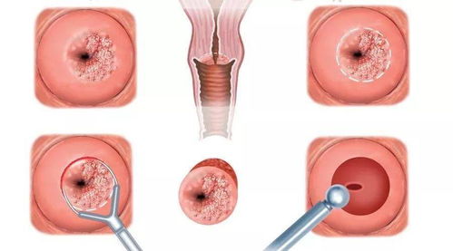 女人感染了HPV,一定是老公出轨了吗