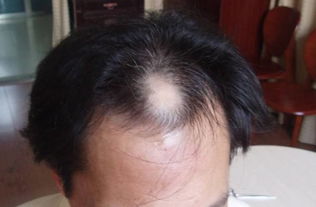 脱发对患者的危害具体有哪些 