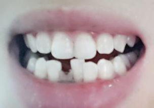麦芽口腔知识分享 儿童牙齿摔断了怎么办 