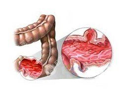 肠胃炎病有什么症状及表现,胃肠炎的症状表现有哪些