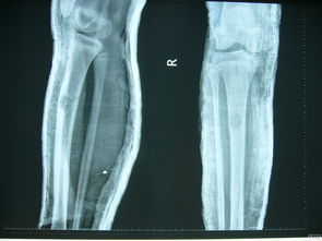 右侧胫骨中上段粉粹性骨折 图片信息欣赏 图客 Tukexw Com
