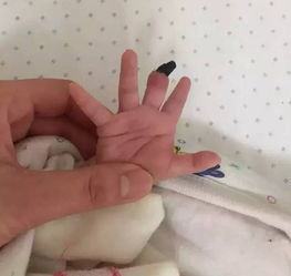 23天大的宝宝手指要截肢,只因戴了这东西 这病不少见,孩爸孩妈赶紧看孩子一眼吧