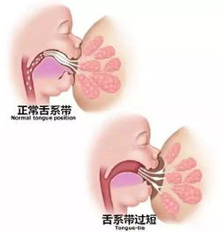 舌系带手术方法