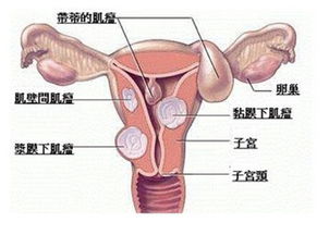 如何避免子宫肌瘤产生与保养