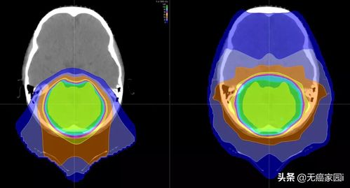脑膜瘤最适合的治疗方法是质子治疗？这是真的吗？
