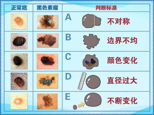 身上有些痣是对称的